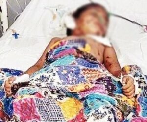 नारेगावात मोकाट कुत्र्यांनी केला ४ वर्षीय चिमुकलीवर हल्ला; शरीरावर 50 हून अधिक गंभीर जखमा